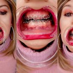 Braces fetish! See Alexandra Braces with an open mouth expander