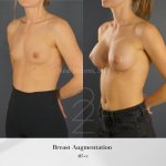 Breast Augmentation in Salt Lake City Utah