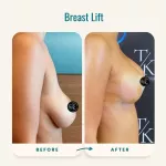 Breast Lift