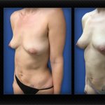 Natural Breast Augmentation