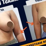 Breast Lift