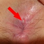 Anal fissure