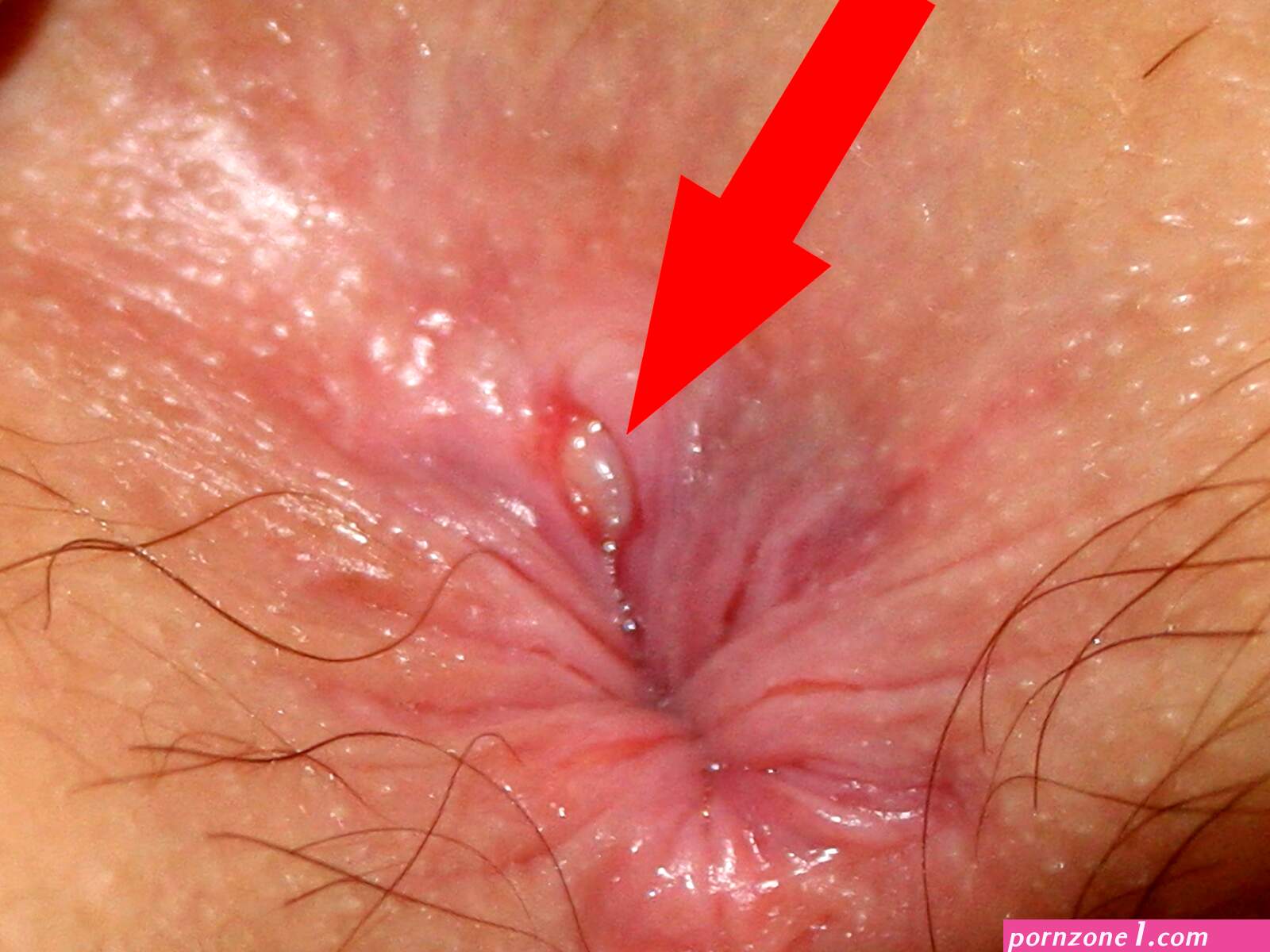 Torn anal (photos)